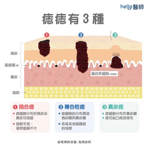 身體有痣|痣變大、痣多或長毛會變皮膚癌？認識痣的形成與原因